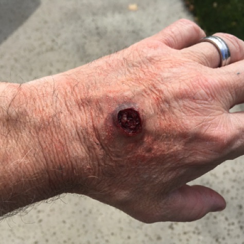 Prosthetic Wound Bullet Hole